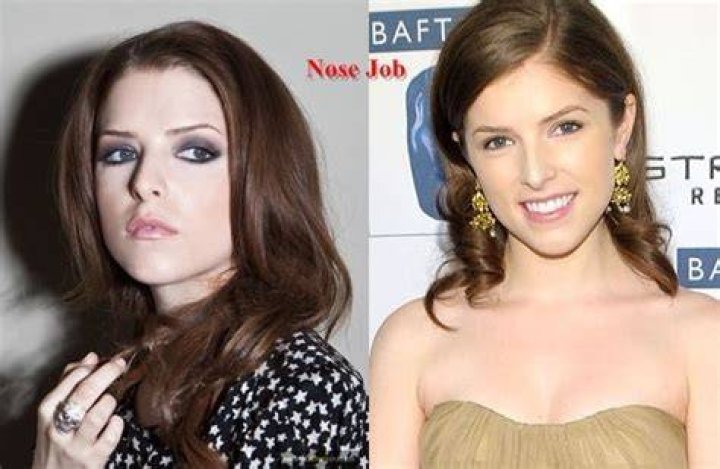 Anna Kendrick Plastic Surgery Before and After