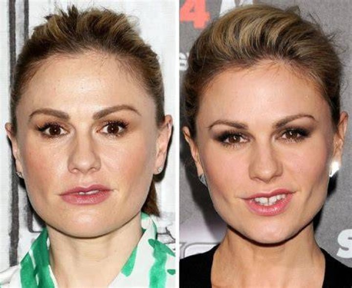 Anna Paquin Plastic Surgery Before and After