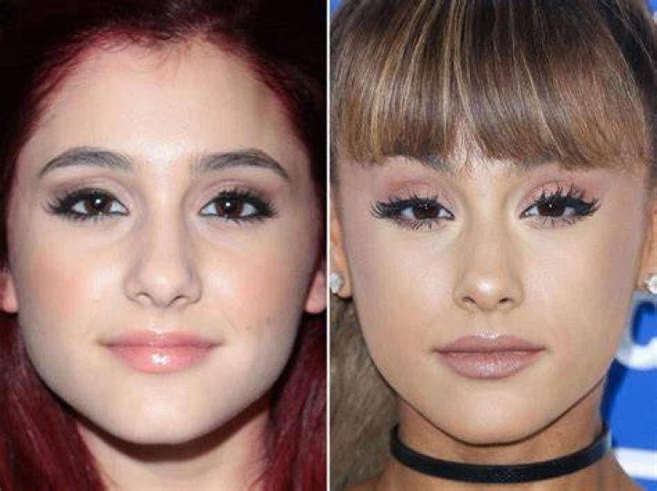 Ariana Grande Plastic Surgery Before and After
