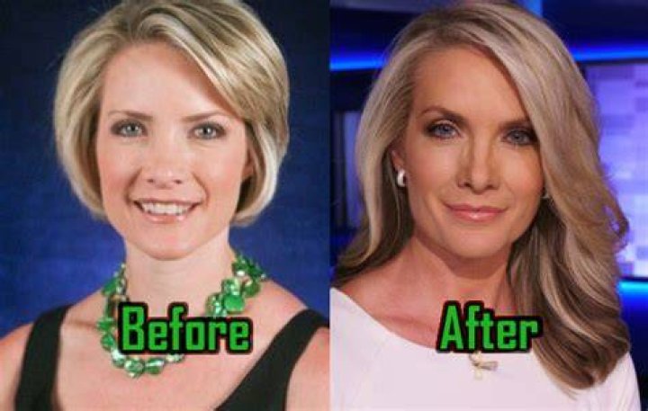 Dana Perino Plastic Surgery: Aging Gracefully or Nipped and Tucked?