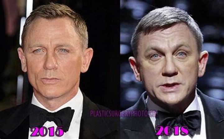 Daniel Craig Plastic Surgery Before and After