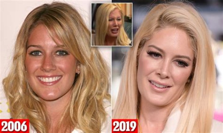 Heidi Montag Plastic Surgery Before and After