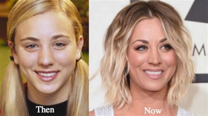 kaley cuoco plastic surgery