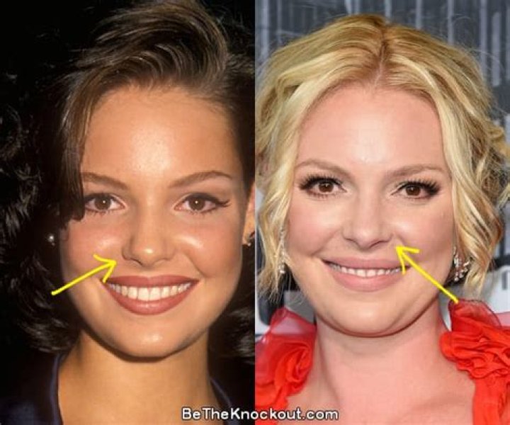 Katherine Heigl Plastic Surgery Before and After