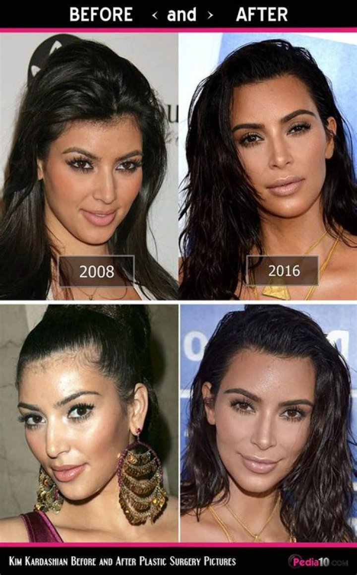 Kim Kardashian Plastic Surgery Before and After