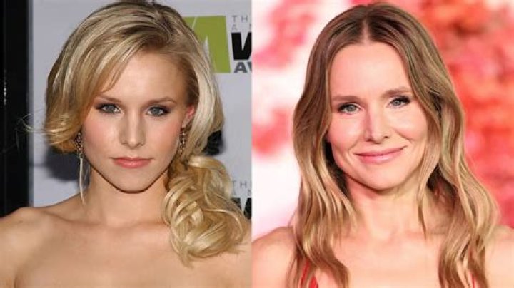 Kristen Bell Plastic Surgery Before and After