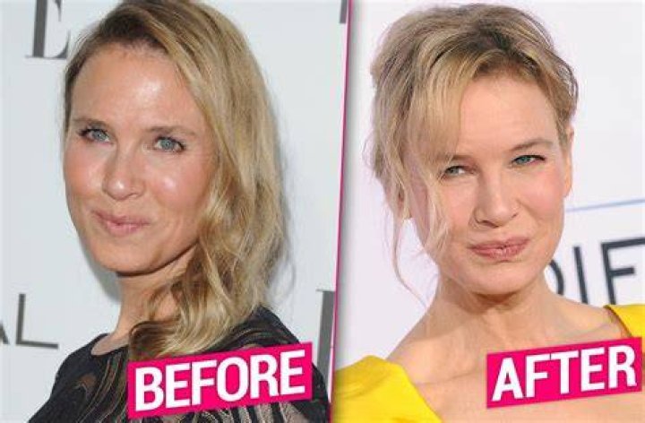 Renee Zellweger Plastic Surgery: Exploring the Truth Behind the Celebrity Facelift Speculation