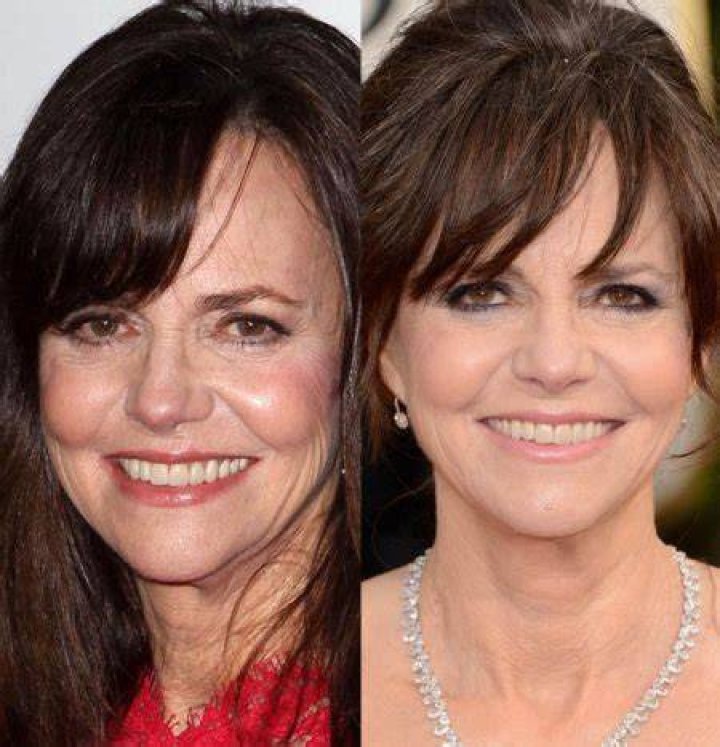 Sally Field Facelift Plastic Surgery Before and After