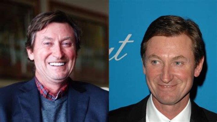 wayne gretzky plastic surgery